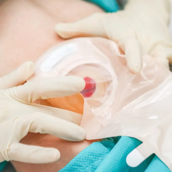 Stoma